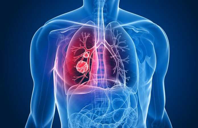 bigstock-lung-tumor-7170754-900x580