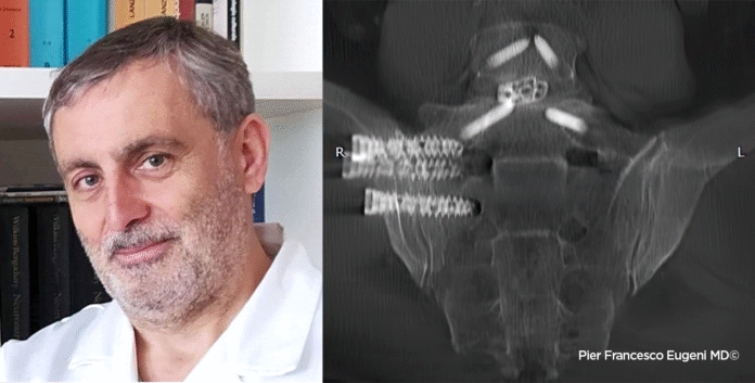 A Villa dei Fiori a Mugnano innovativo intervento di artrodesi sacroiliaca - Pierfrancesco Eugeni