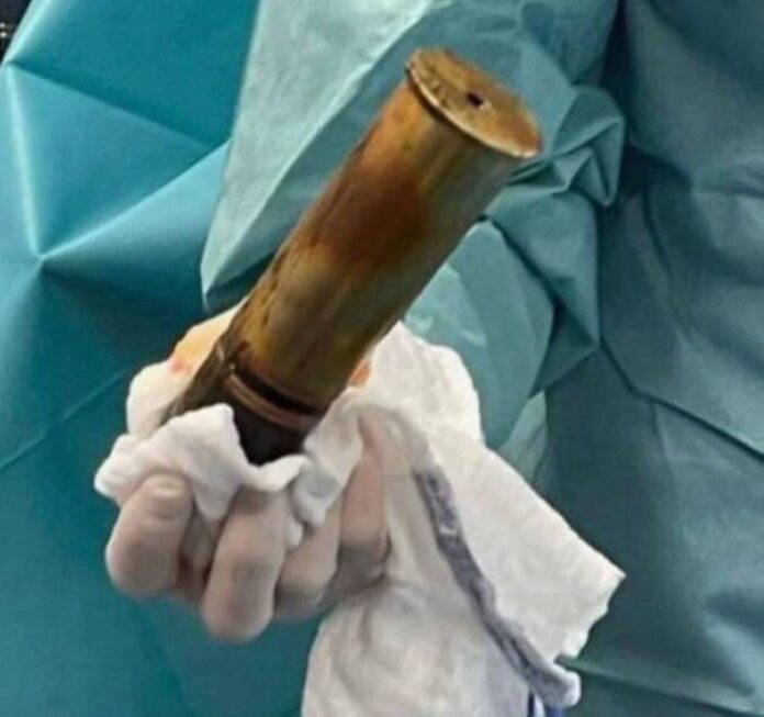 SI INFILA UNA GRANATA NELL'ANO E FINISCE IN OSPEDALE