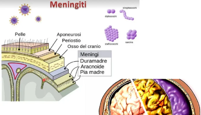 meningite tubercolare